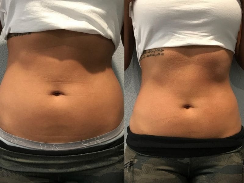 fat-freezing-what-to-expect-cryoskin-body
